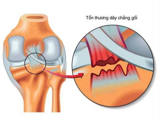 chấn thương đứt dây chằng đầu gối