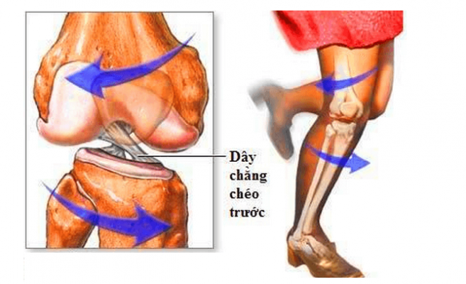 chấn thương đứt dây chằng đầu gối